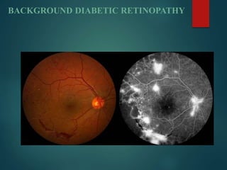 BACKGROUND DIABETIC RETINOPATHY
 