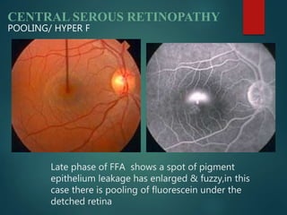 CENTRAL SEROUS RETINOPATHY
POOLING/ HYPER F
Late phase of FFA shows a spot of pigment
epithelium leakage has enlarged & fuzzy,in this
case there is pooling of fluorescein under the
detched retina
 