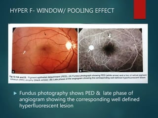 HYPER F- WINDOW/ POOLING EFFECT
 Fundus photography shows PED & late phase of
angiogram showing the corresponding well defined
hyperfluorescent lesion
 