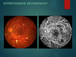 HYPERTENSIVE RETINOPATHY
 