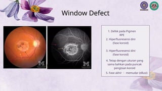 Window Defect Ffa Hyper Comprehensive Guide to Fundus Fluorescein Angiography (FFA) in Ocular ...