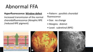 Window Defect Ffa Hyper fundus fluorescein and indocyanine green angiography | PPTX