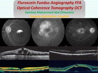 Fluroscein Fundus Angiography FFA
Optical Coherence Tomography OCT
Samhaa Mohammed Abd Elmoneim
Zagazig Ophthalmic Hospital
 