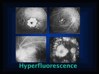 Hyperfluorescence

 