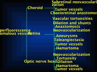 Choroid

perfluorescence
Retina
omalous vessels

Subretinal neovascularization
Tumor vessels
Chorioretinal anastomos
Vascular tortuosities
Dilation and shunts
Anastomosis
Neovascularization
Aneurysms
Teleangiectasia
Tumor vessels
Hamartoma

Neovascularization
Tortuosity
Optic nerve head Dilation
Hamartoma
Tumor vessels

 