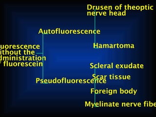 Drusen of theoptic
nerve head
Autofluorescence

uorescence
ithout the
dministration
f fluorescein

Hamartoma
Scleral exudate

Scar tissue
Pseudofluorescence
Foreign body

Myelinate nerve fibe

 