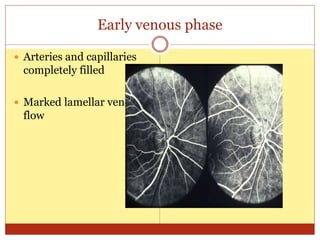 Early venous phase
 Arteries and capillaries
completely filled
 Marked lamellar venous
flow
 
