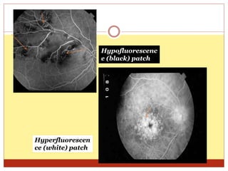 Hypofluorescenc
e (black) patch
Hyperfluorescen
ce (white) patch
 