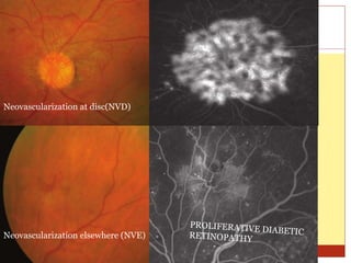 Neovascularization at disc(NVD)
Neovascularization elsewhere (NVE)
 