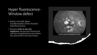 fundus fluorescein Angiography ppt presentation | PPTX