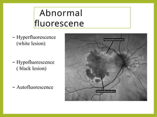 Comprehensive Guide to Fluorescein Angiography in Ophthalmology | PPTX