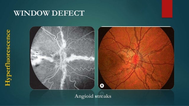 WINDOW DEFECT Hyperfluorescence Angioid Streaks WINDOW DEFECT Hyperfluorescence Angioid Streaks