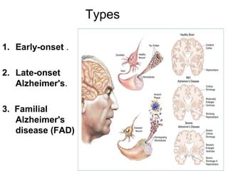 Types
1. Early-onset .
2. Late-onset
Alzheimer's.
3. Familial
Alzheimer's
disease (FAD)
 