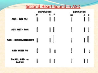 Second Heart Sound In ASD
 