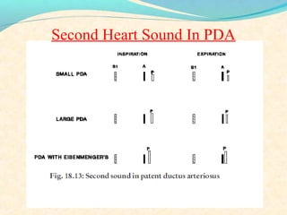Second Heart Sound In PDA
 