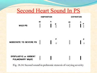 Second Heart Sound In PS
 
