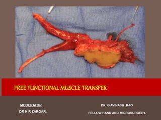 DR G AVINASH RAO
FELLOW HAND AND MICROSURGERY.
FREE FUNCTIONALMUSCLE TRANSFER
MODERATOR
DR H R ZARGAR.
 