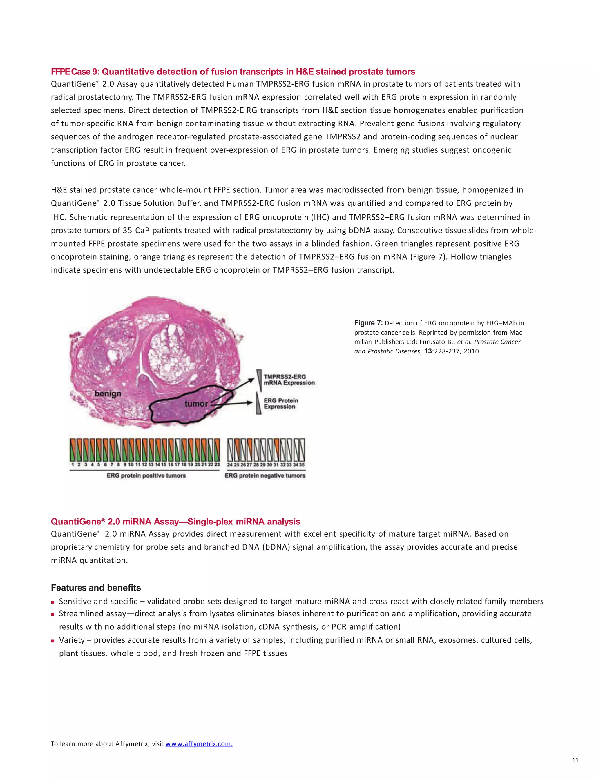To learn more about Affymetrix, visit www.affymetrix.com.
11
FFPECase 9: Quantitative detection of fusion transcripts in H&E stained prostate tumors
QuantiGene® 2.0 Assay quantitatively detected Human TMPRSS2-ERG fusion mRNA in prostate tumors of patients treated with
radical prostatectomy. The TMPRSS2-ERG fusion mRNA expression correlated well with ERG protein expression in randomly
selected specimens. Direct detection of TMPRSS2-E RG transcripts from H&E section tissue homogenates enabled purification
of tumor-specific RNA from benign contaminating tissue without extracting RNA. Prevalent gene fusions involving regulatory
sequences of the androgen receptor-regulated prostate-associated gene TMPRSS2 and protein-coding sequences of nuclear
transcription factor ERG result in frequent over-expression of ERG in prostate tumors. Emerging studies suggest oncogenic
functions of ERG in prostate cancer.
H&E stained prostate cancer whole-mount FFPE section. Tumor area was macrodissected from benign tissue, homogenized in
QuantiGene® 2.0 Tissue Solution Buffer, and TMPRSS2-ERG fusion mRNA was quantified and compared to ERG protein by
IHC. Schematic representation of the expression of ERG oncoprotein (IHC) and TMPRSS2–ERG fusion mRNA was determined in
prostate tumors of 35 CaP patients treated with radical prostatectomy by using bDNA assay. Consecutive tissue slides from whole-
mounted FFPE prostate specimens were used for the two assays in a blinded fashion. Green triangles represent positive ERG
oncoprotein staining; orange triangles represent the detection of TMPRSS2–ERG fusion mRNA (Figure 7). Hollow triangles
indicate specimens with undetectable ERG oncoprotein or TMPRSS2–ERG fusion transcript.
Figure 7: Detection of ERG oncoprotein by ERG–MAb in
prostate cancer cells. Reprinted by permission from Mac-
millan Publishers Ltd: Furusato B., et al. Prostate Cancer
and Prostatic Diseases, 13:228-237, 2010.
QuantiGene® 2.0 miRNA Assay—Single-plex miRNA analysis
QuantiGene® 2.0 miRNA Assay provides direct measurement with excellent specificity of mature target miRNA. Based on
proprietary chemistry for probe sets and branched DNA (bDNA) signal amplification, the assay provides accurate and precise
miRNA quantitation.
Features and benefits
 Sensitive and specific – validated probe sets designed to target mature miRNA and cross-react with closely related family members
 Streamlined assay—direct analysis from lysates eliminates biases inherent to purification and amplification, providing accurate
results with no additional steps (no miRNA isolation, cDNA synthesis, or PCR amplification)
 Variety – provides accurate results from a variety of samples, including purified miRNA or small RNA, exosomes, cultured cells,
plant tissues, whole blood, and fresh frozen and FFPE tissues
 