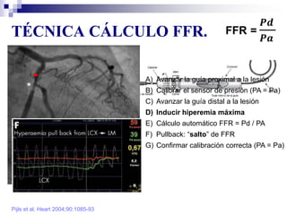 TÉCNICA CÁLCULO FFR.
Pijls et al. Heart 2004;90:1085-93
A) Avanzar la guía proximal a la lesión
B) Calibrar el sensor de presión (PA = Pa)
C) Avanzar la guía distal a la lesión
D) Inducir hiperemia máxima
E) Cálculo automático FFR = Pd / PA
F) Pullback: “salto” de FFR
G) Confirmar calibración correcta (PA = Pa)
*
 