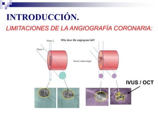 INTRODUCCIÓN.
LIMITACIONES DE LA ANGIOGRAFÍA CORONARIA:
IVUS / OCT
 
