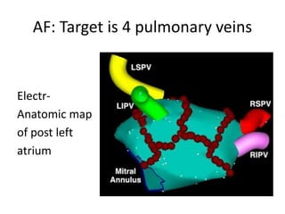 AF: Target is 4 pulmonary veins
Electr-
Anatomic map
of post left
atrium
 