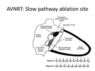AVNRT: Slow pathway ablation site
 