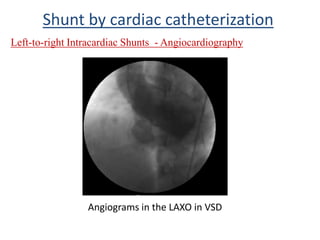 Left-to-right Intracardiac Shunts - Angiocardiography
Shunt by cardiac catheterization
Angiograms in the LAXO in VSD
 