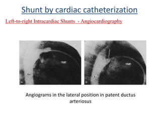 Left-to-right Intracardiac Shunts - Angiocardiography
Shunt by cardiac catheterization
Angiograms in the lateral position in patent ductus
arteriosus
 