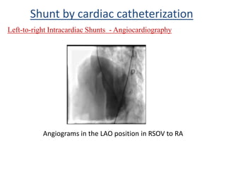 Left-to-right Intracardiac Shunts - Angiocardiography
Shunt by cardiac catheterization
Angiograms in the LAO position in RSOV to RA
 