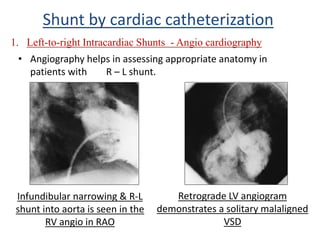 • Angiography helps in assessing appropriate anatomy in
patients with R – L shunt.
Shunt by cardiac catheterization
1. Left-to-right Intracardiac Shunts - Angio cardiography
Retrograde LV angiogram
demonstrates a solitary malaligned
VSD
Infundibular narrowing & R-L
shunt into aorta is seen in the
RV angio in RAO
 