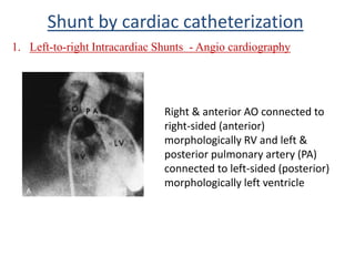Right & anterior AO connected to
right-sided (anterior)
morphologically RV and left &
posterior pulmonary artery (PA)
connected to left-sided (posterior)
morphologically left ventricle
Shunt by cardiac catheterization
1. Left-to-right Intracardiac Shunts - Angio cardiography
 
