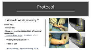 French Functional Method for Congenital Clubfoot: 20 years of ...