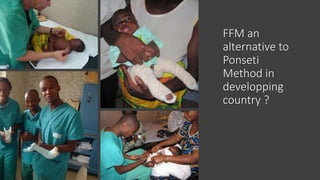 French Functional Method for Congenital Clubfoot: 20 years of ...