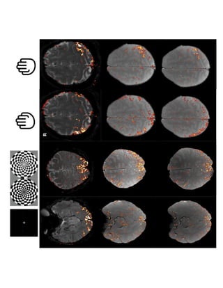 3D dual-echo UTE Rosette fMRI 