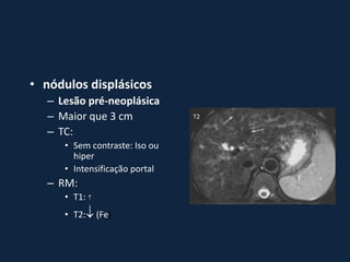 • nódulos displásicos
   – Lesão pré-neoplásica
   – Maior que 3 cm             T2

   – TC:
      • Sem contraste: Iso ou
        hiper
      • Intensificação portal
   – RM:
      • T1: 
      • T2: (Fe)
 