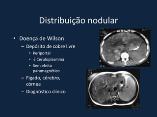 Distribuição nodular
                                   TC

• Doença de Wilson
  – Depósito de cobre livre
     • Periportal
     •  Ceruloplasmina
     • Sem efeito
       paramagnético          T2
  – Figado, cérebro,
    córnea
  – Diagnóstico clínico
 
