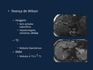 • Doença de Wilson

  – Imagem:
     • Sem achados
       específicos
     • Hepatomegalia,
       esteatose, cirrose

  – TC:

     • Nódulos hiperdensos
  – RNM
     • Nódulos  T2 e  T1
 