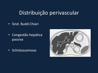 Distribuição perivascular
• Sind. Budd-Chiari

• Congestão hepática
  passiva

• Schistossomose
 