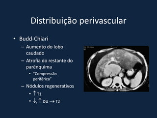 Distribuição perivascular
• Budd-Chiari
  – Aumento do lobo
    caudado
  – Atrofia do restante do
    parênquima
     • “Compressão
       periférica”
  – Nódulos regenerativos
     •  T1
     • ,  ou  T2
 
