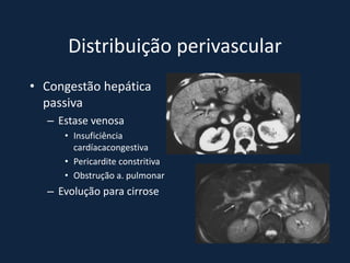 Distribuição perivascular
• Congestão hepática
  passiva
  – Estase venosa
     • Insuficiência
       cardíacacongestiva
     • Pericardite constritiva
     • Obstrução a. pulmonar
  – Evolução para cirrose
 