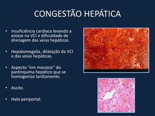 CONGESTÃO HEPÁTICA
• Insuficiência cardíaca levando a
  estase na VCI e dificuldade de
  drenagem das veias hepáticas.

• Hepatomegalia, dilatação da VCI
  e das veias hepáticas.

• Aspecto “em mosaico” do
  parênquima hepático que se
  homogeniza tardiamente.

• Ascite.

• Halo periportal.
 