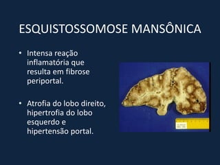 ESQUISTOSSOMOSE MANSÔNICA
• Intensa reação
  inflamatória que
  resulta em fibrose
  periportal.

• Atrofia do lobo direito,
  hipertrofia do lobo
  esquerdo e
  hipertensão portal.
 