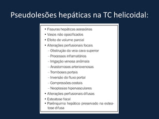 Pseudolesões hepáticas na TC helicoidal:
 