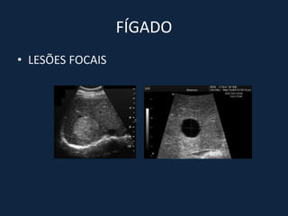 FÍGADO
• LESÕES FOCAIS
 