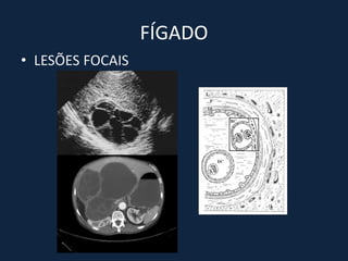 FÍGADO
• LESÕES FOCAIS
 