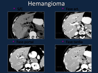 Hemangioma
 S/C              Fase art.




 Fase portal      Fase tardia
 