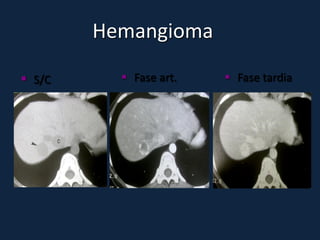 Hemangioma

 S/C      Fase art.    Fase tardia
 