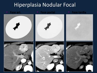 Hiperplasia Nodular Focal
 Fase art.    Fase portal    Fase tardia
 