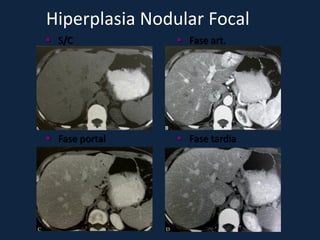 Hiperplasia Nodular Focal
 S/C            Fase art.




 Fase portal    Fase tardia
 