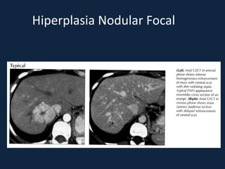 Hiperplasia Nodular Focal
 